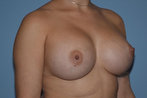 Breast Augmentation Before & After Gallery - Patient 387942 - Image 4