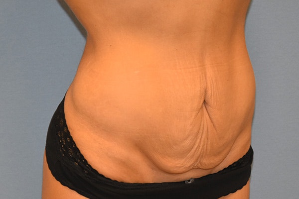 Tummy Tuck Before & After Gallery - Patient 391516 - Image 3
