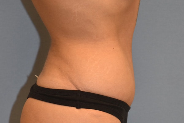 Tummy Tuck Before & After Gallery - Patient 391516 - Image 6