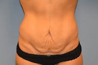 Tummy Tuck Before & After Gallery - Patient 391516 - Image 1