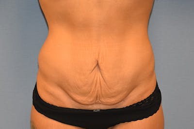 Tummy Tuck Before & After Gallery - Patient 391516 - Image 1