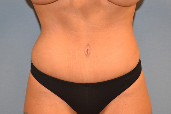 Tummy Tuck Before & After Gallery - Patient 391516 - Image 2