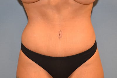 Tummy Tuck Before & After Gallery - Patient 391516 - Image 2