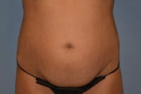 Tummy Tuck Before & After Gallery - Patient 792725 - Image 1