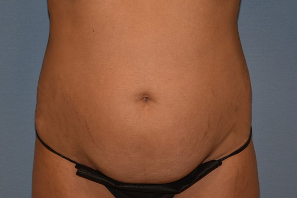 Tummy Tuck Before & After Gallery - Patient 792725 - Image 1