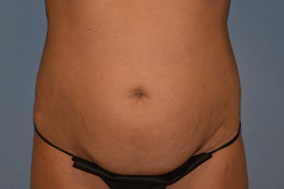 Tummy Tuck Before & After Gallery - Patient 792725 - Image 1