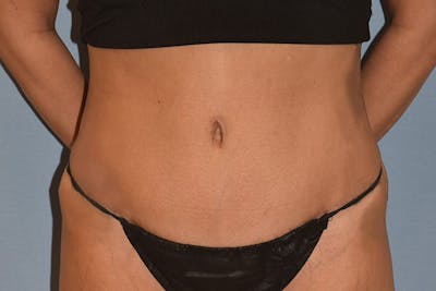 Tummy Tuck Before & After Gallery - Patient 792725 - Image 2