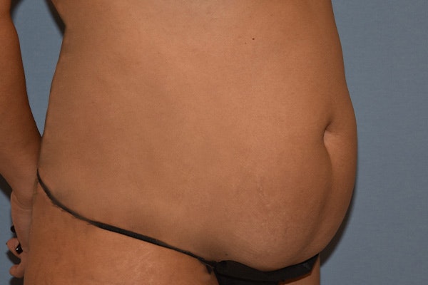 Tummy Tuck Before & After Gallery - Patient 792725 - Image 3