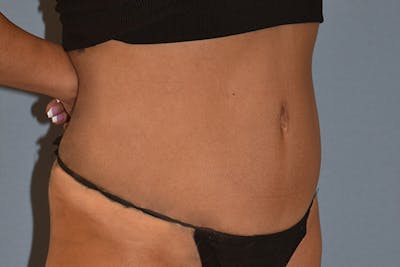 Tummy Tuck Before & After Gallery - Patient 792725 - Image 4
