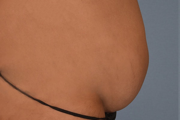Tummy Tuck Before & After Gallery - Patient 792725 - Image 5