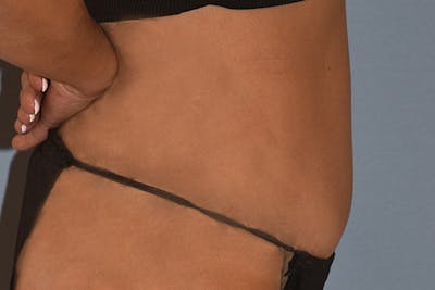 Tummy Tuck Before & After Gallery - Patient 792725 - Image 6