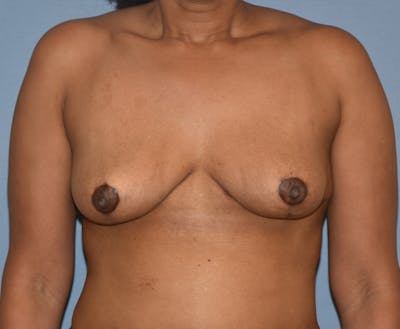 Breast Reduction Before & After Gallery - Patient 313615 - Image 2