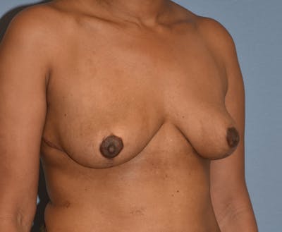 Breast Reduction Before & After Gallery - Patient 313615 - Image 4