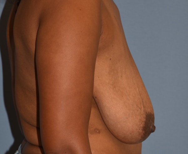 Breast Reduction Before & After Gallery - Patient 313615 - Image 5