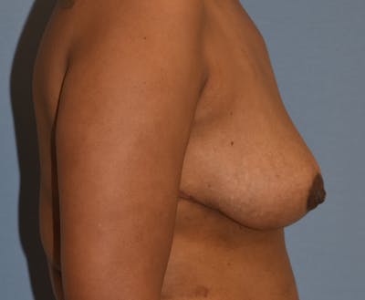 Breast Reduction Before & After Gallery - Patient 313615 - Image 6