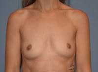 Breast Augmentation Before & After Gallery - Patient 335559 - Image 1
