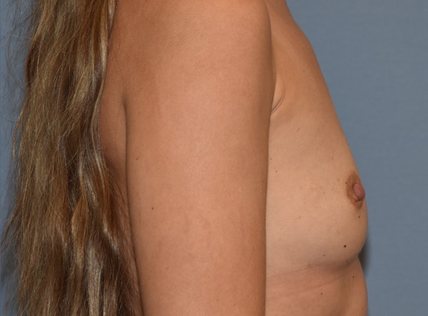 Breast Augmentation Before & After Gallery - Patient 335559 - Image 5