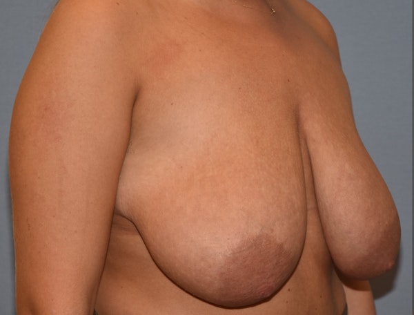 Breast Reduction Before & After Gallery - Patient 364707 - Image 3