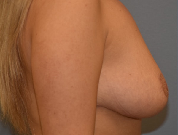 Breast Reduction Before & After Gallery - Patient 364707 - Image 6
