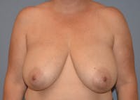 Breast Reduction Before & After Gallery - Patient 356732 - Image 1