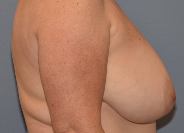 Breast Reduction Before & After Gallery - Patient 356732 - Image 5