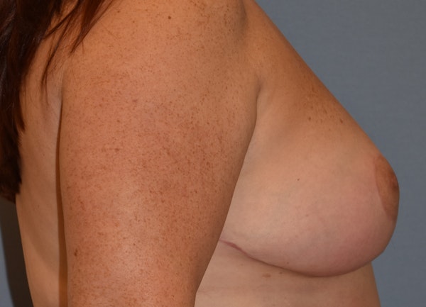 Breast Reduction Before & After Gallery - Patient 356732 - Image 6