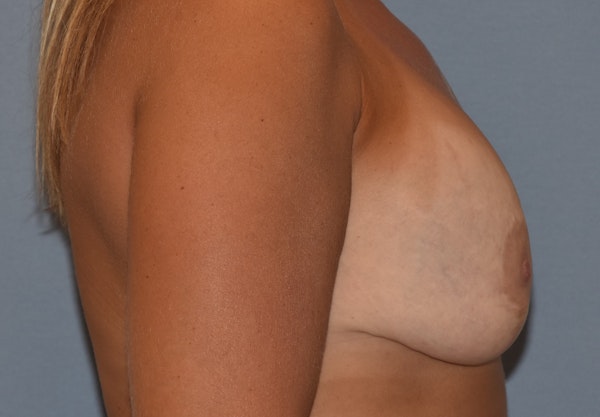 Breast Revision Before & After Gallery - Patient 291748 - Image 5