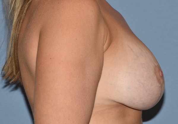 Breast Revision Before & After Gallery - Patient 291748 - Image 6