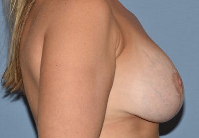 Breast Revision Before & After Gallery - Patient 291748 - Image 6