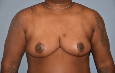 Breast Reduction Before & After Gallery - Patient 362166 - Image 2