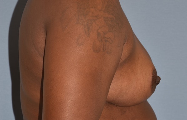 Breast Reduction Before & After Gallery - Patient 362166 - Image 6
