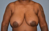 Breast Reduction Before & After Gallery - Patient 362166 - Image 1