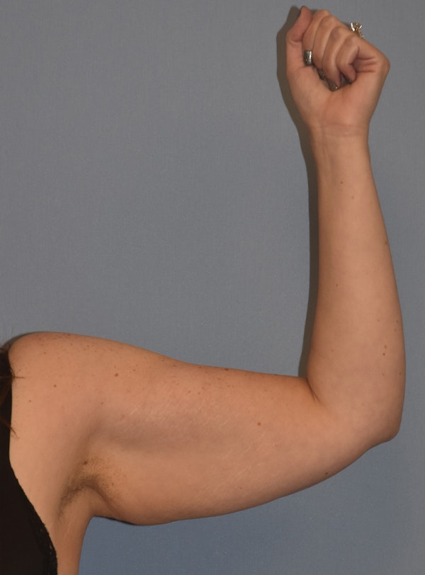Arm Lift Before & After Gallery - Patient 186081 - Image 3