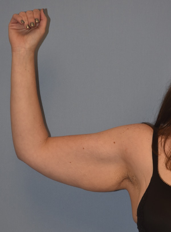Arm Lift Before & After Gallery - Patient 186081 - Image 7