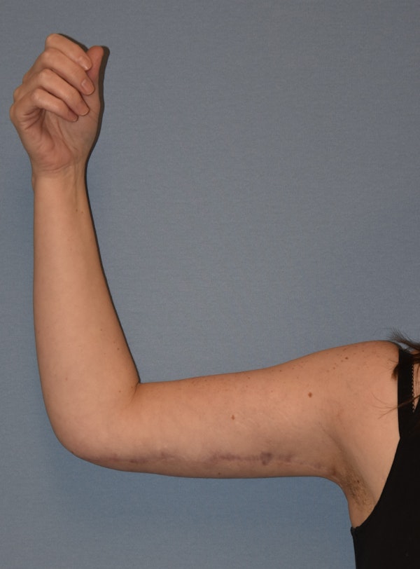 Arm Lift Before & After Gallery - Patient 186081 - Image 8