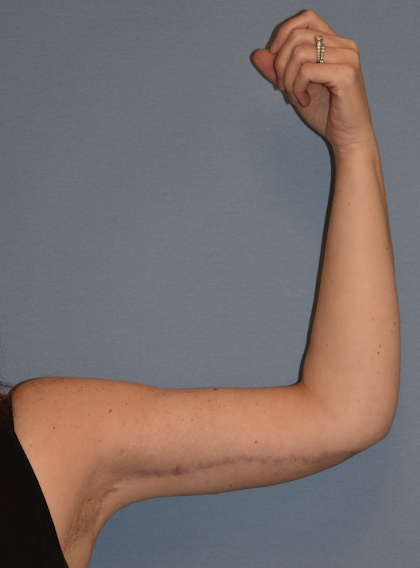 Arm Lift Before & After Gallery - Patient 186081 - Image 4