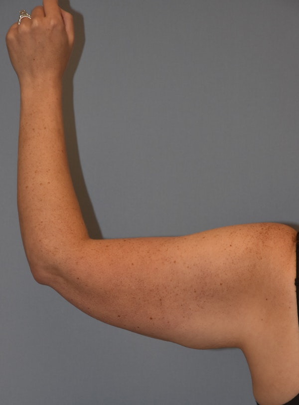 Arm Lift Before & After Gallery - Patient 186081 - Image 5