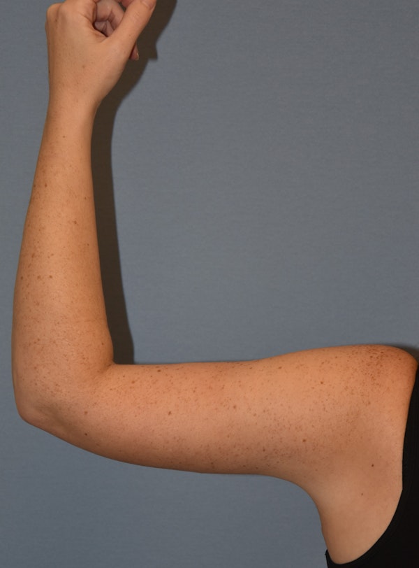 Arm Lift Before & After Gallery - Patient 186081 - Image 6