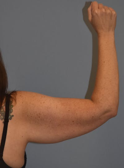 Arm Lift Before & After Gallery - Patient 186081 - Image 1