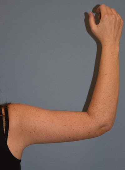 Arm Lift Before & After Gallery - Patient 186081 - Image 2