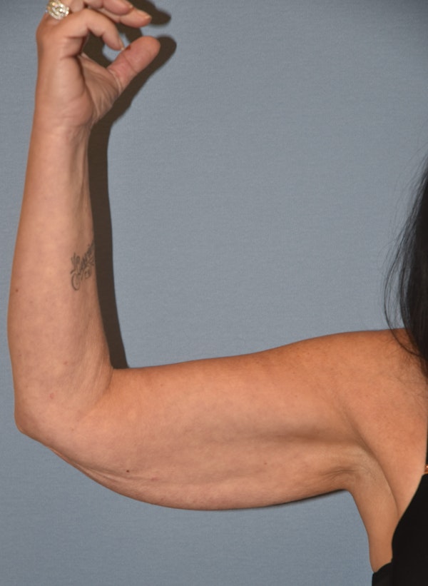 Arm Lift Before & After Gallery - Patient 211254 - Image 5