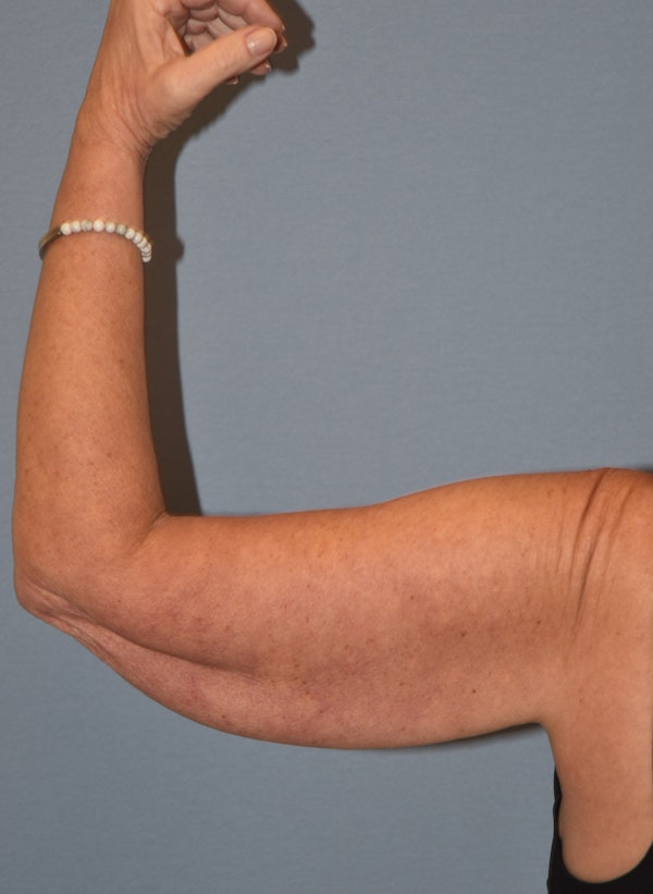 Arm Lift Before & After Gallery - Patient 211254 - Image 7