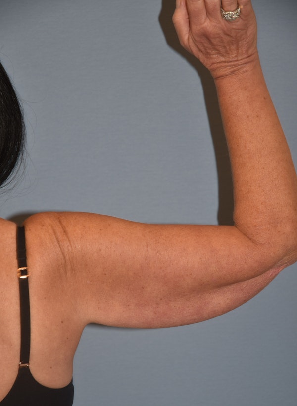 Arm Lift Before & After Gallery - Patient 211254 - Image 3