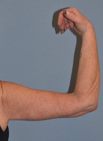 Arm Lift Before & After Gallery - Patient 211254 - Image 4