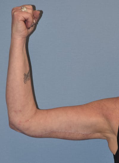 Arm Lift Before & After Gallery - Patient 211254 - Image 6