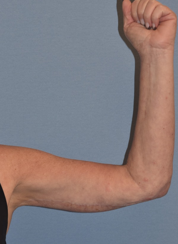 Arm Lift Before & After Gallery - Patient 211254 - Image 2
