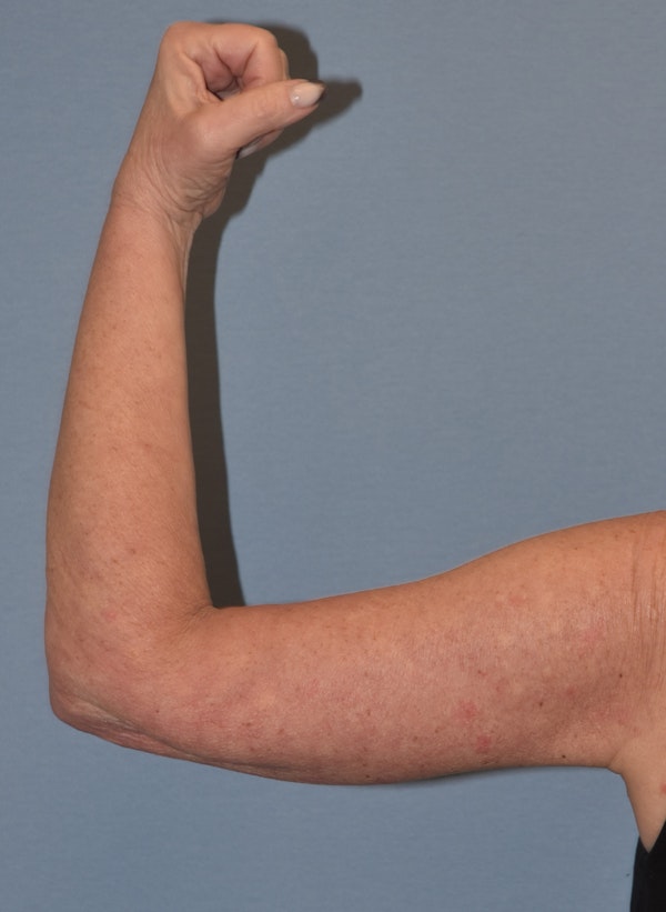 Arm Lift Before & After Gallery - Patient 211254 - Image 8