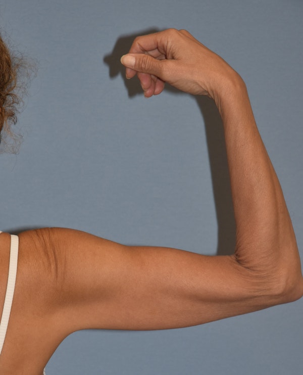 Arm Lift Before & After Gallery - Patient 202496 - Image 3