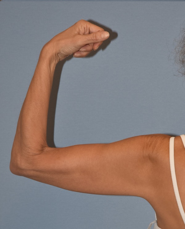 Arm Lift Before & After Gallery - Patient 202496 - Image 5