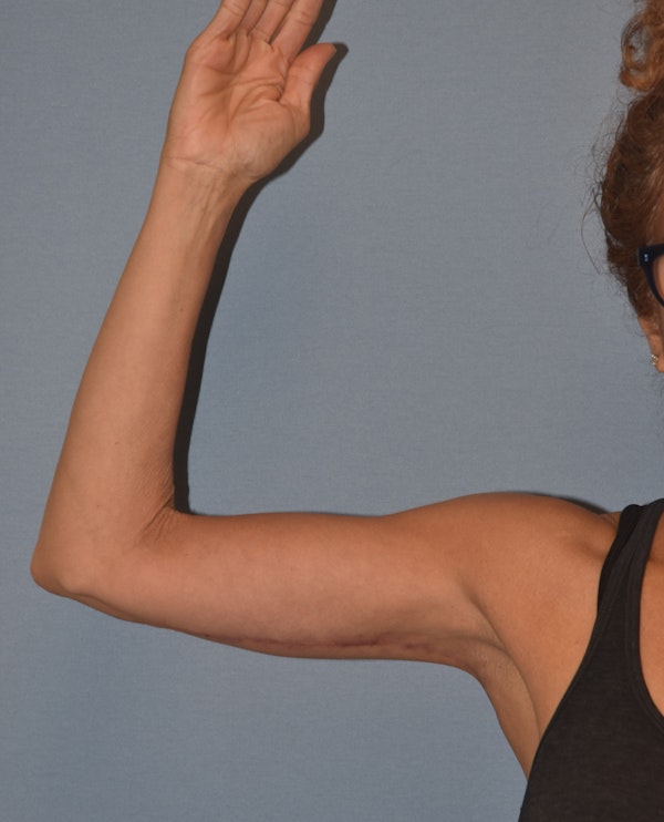 Arm Lift Before & After Gallery - Patient 202496 - Image 8
